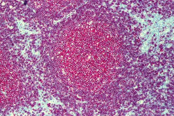 Microscopic pathology slide of follicular lymphoma tissue, stained in purple and pink, showing the characteristic follicular pattern of this type of cancer.