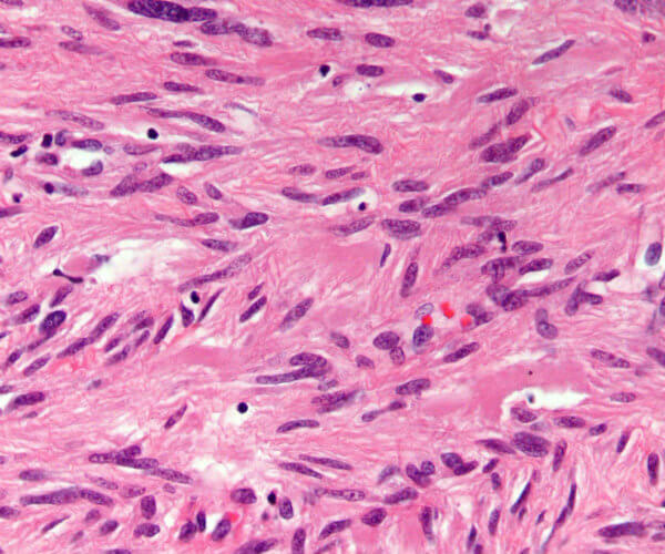 A pathology slide of a gastrointestinal stromal tumor.