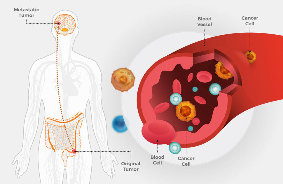 A two panel illustration. On the left, a human body with detailed illustrations of the brain and intestines. The brain has a circle labeled Metastatic Tumor, and an arrow points from the tumor to a circle in the intestine, labeled Original Tumor. On the right, a close up of a blood vessel, labeling the blood vessel, cancer cell, blood cell, and cancer cell inside the bloodstream.