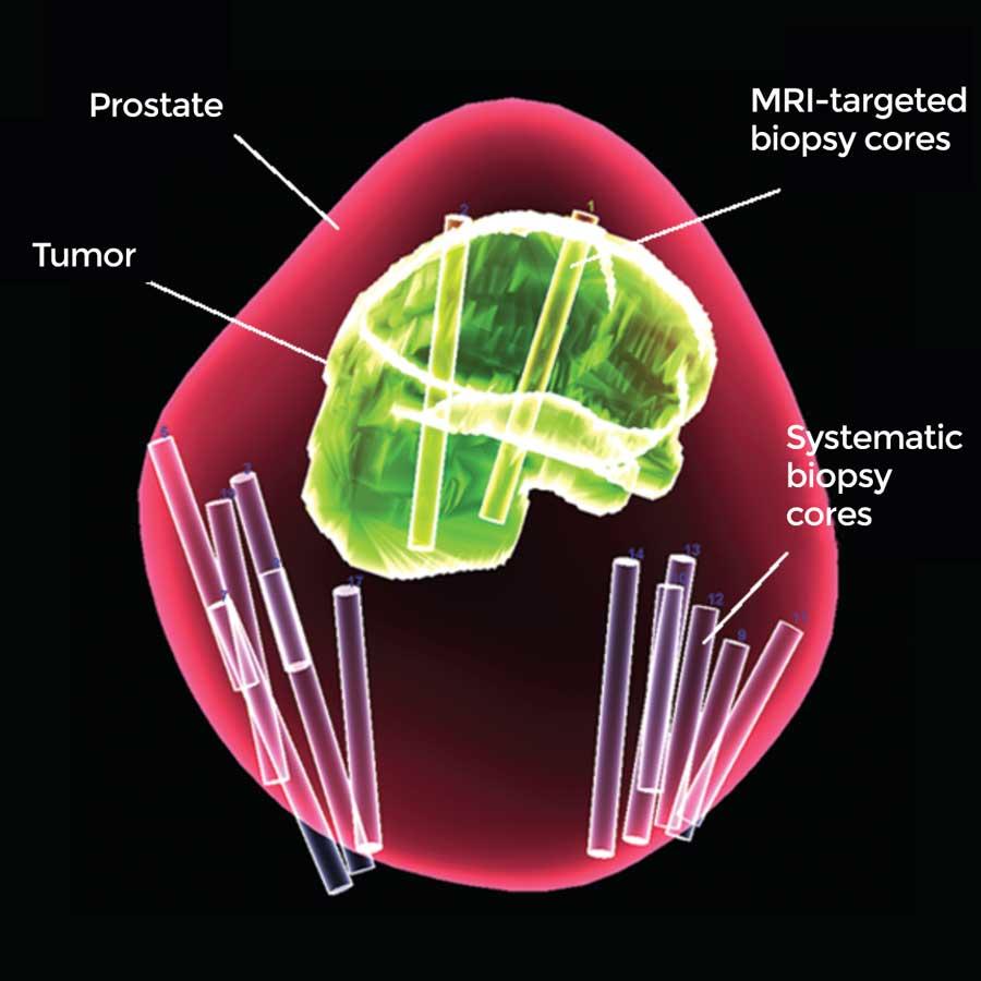 A 3-dimensional map of the prostate using combined MRI-targeted and systematic biopsies