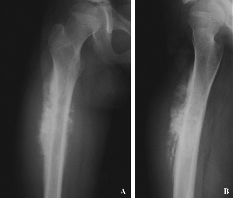 An x-ray of a femur (thigh bone) from a patient with osteosarcoma.
