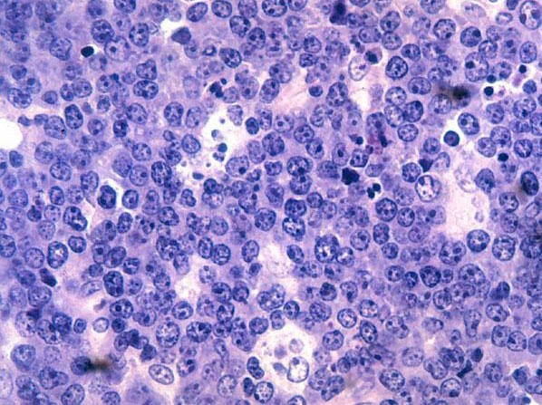 Malignant B-cell lymphocytes seen in Burkitt lymphoma.