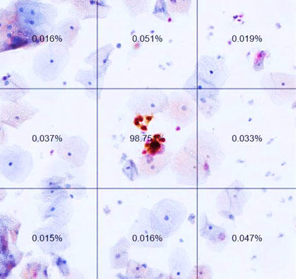 A slide from an automated dual-stain cytology test.