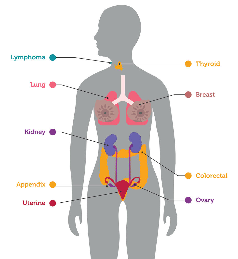 An illustration highlighting organs in which cancers were detected by an experimental blood test.