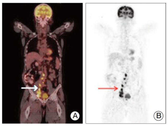 Two medical scans highlighting the body's interior. Scan A on the left is a colored PET/CT scan showing areas of active metabolism and potential abnormalities, with a white arrow indicating significant activity in the abdominal area. Scan B on the right is a grayscale image displaying similar metabolic activity, with a red arrow pointing to a focus of interest in the lower chest region. 