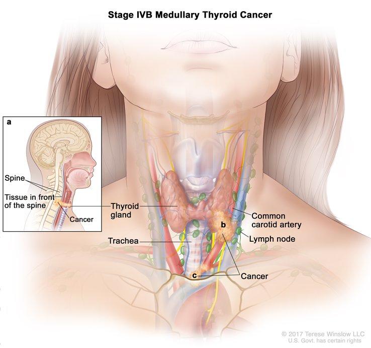 Illustration of Stage IVB Medullary Thyroid Cancer. It shows a detailed view of the neck, highlighting the thyroid gland, trachea, and common carotid artery. An inset on the left depicts a side view of the head and neck, with labels for the the spine and tissue in front of the spine as well as an area labeled "Cancer." The image illustrates how the cancer spreads in the neck region.