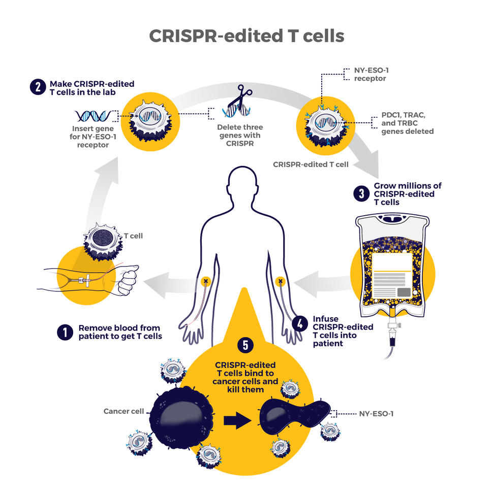 Infographic showing the 5-step process of CRISPR-edited T cell therapy for cancer treatment: 1) Remove blood from patient to get T cells, 2) Make CRISPR-edited T cells in the lab by inserting NY-ESO-1 receptor genes and deleting PDC1, TRAC, and TRBC genes, 3) Grow millions of modified T cells, 4) Infuse the CRISPR-edited T cells back into the patient, and 5) Modified T cells bind to cancer cells and kill them