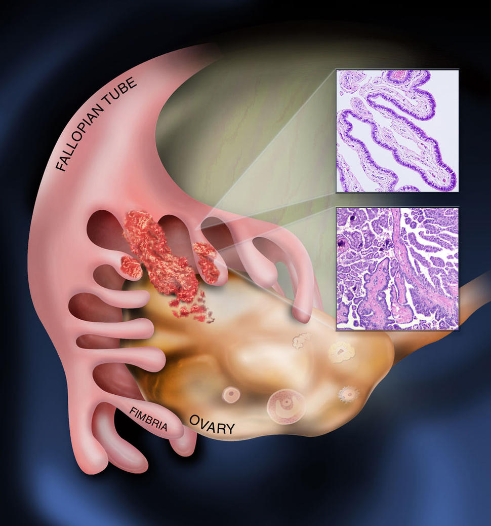 Illustration showing ovarian cancer starting in the fallopian tube