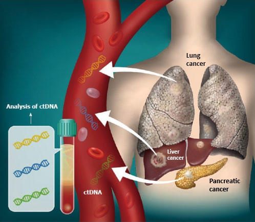Pancreatic Cancer Liquid Biopsy