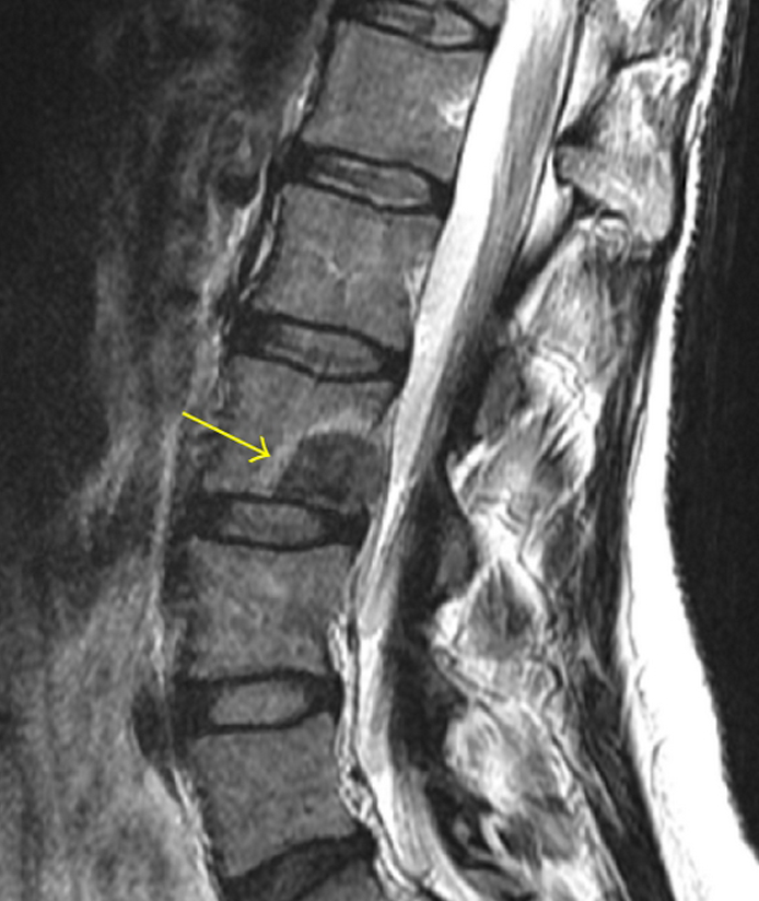 An image of an MRI showing a metastatic tumor in a patient's spine.