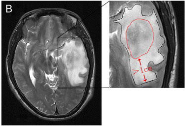 An MRI image of a brain tumor and swelling in the area around it.