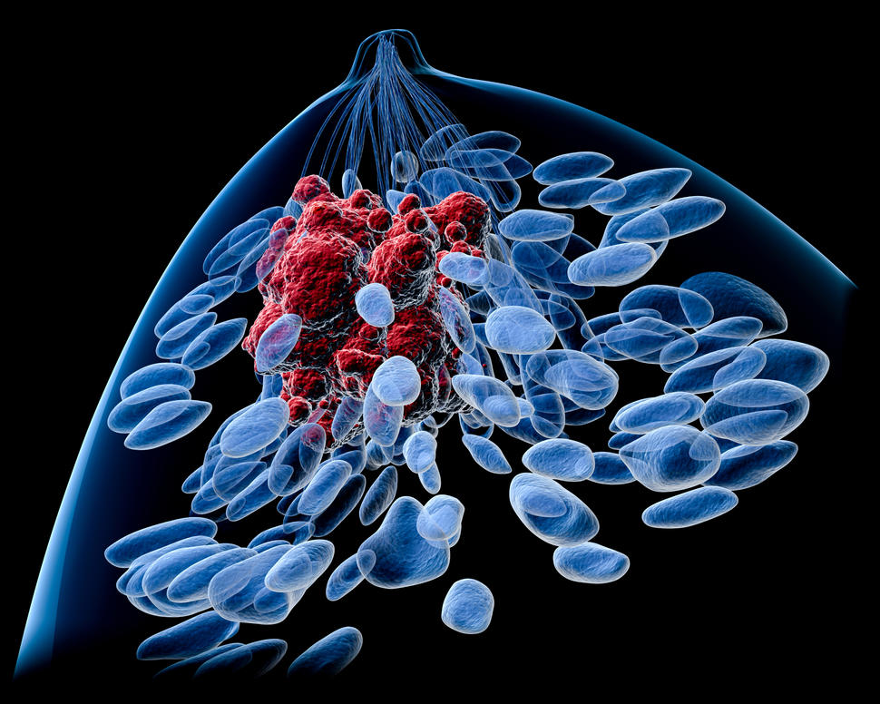 Top view of a female breast with a tumor. Inside of a blue body silhouette, lobules, lactiferous ducts (also blue) and a tumor (in red) can be seen. The background is black.