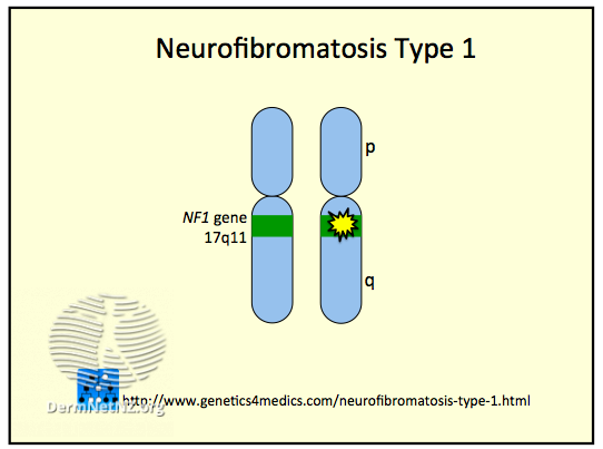 An illustration of a mutated form of the NF1 gene on chromosome 17.