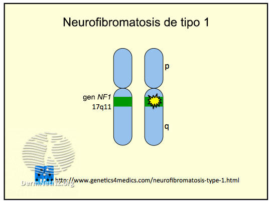 Ilustración de una mutación del gen NF1 en el cromosoma 17.