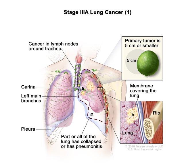 Illustration of Stage IIIA Lung Cancer (1), showing a cross-section of the lungs. Labeled features include cancer in lymph nodes around the trachea, carina, left main bronchus, and pleura. Part of the lung has collapsed or has pneumonitis. Insets show the primary tumor, which is 5 cm or smaller, compared to a lime for size reference, and a close-up of the membrane covering the lung near the rib. 