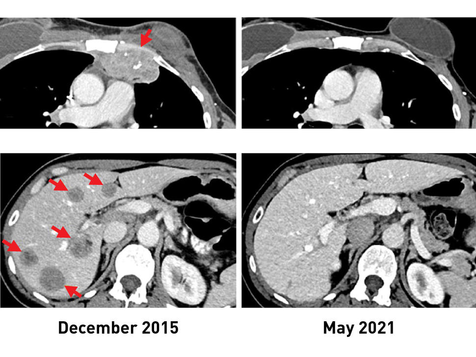 A x-ray photo comparison. On the left, two x-rays dated December 2015 show dark grey spots, which are metastatic lesions, on her chest wall and liver. Red arrows point to the lesions. On the right, two x-rays dated May 2021 show the x-rays in the same orientation, but both are missing the lesions and arrows, indicating the removal of cancer. 