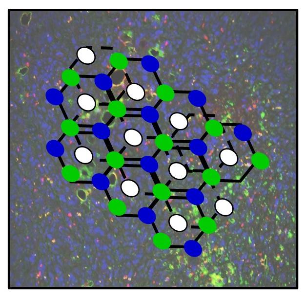 Image of a tumor overlayed with a representative illustration of a graphene material