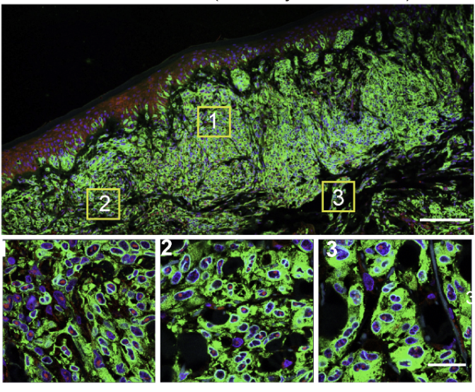 A microscopic image of melanoma cells, highlighting the androgen receptor in cell nuclei. The top panel displays a broad view with green, blue and black areas. Three yellow boxes labeled 1, 2, and 3 indicate areas of interest. The bottom panel provides magnified views of these areas, showing detailed cellular structures.
