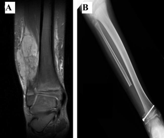 Side-by-side x-ray images. The left image is a close up of a fibula with a large tumor and the x-ray image itself is in shades of dark grey. The right image shows a lower leg with no tumor; the x-ray image is lighter grey and white compared to the left image.