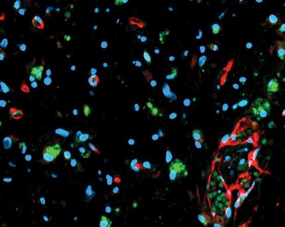 A fluorescence micrograph of glioma organoids.
