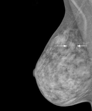 A mammogram with arrows indicating an asymmetry in the upper area of the breast.