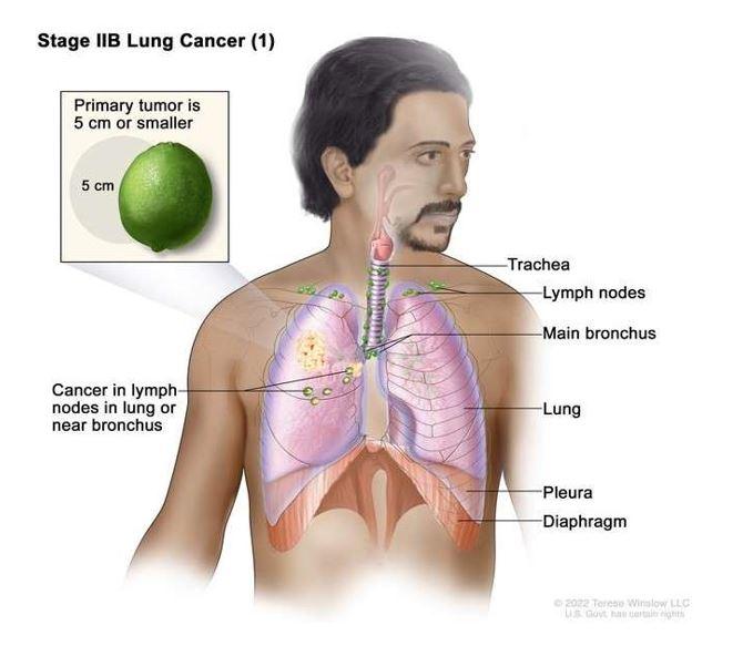 Illustration of a male figure showing the anatomy of the lungs with stage 2B lung cancer