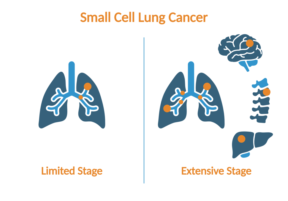 Icons of organs showing that limited stage lung cancer is limited to one side of the lungs while extensive stage lung cancer is in both sides of the lungs and other organs like the brain, bone, and liver.