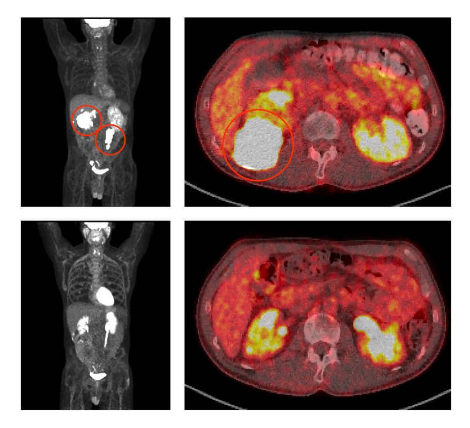 Top two PET scans show large lymphoma tumors (circled) near the right kidney and in the back of the abdomen. Following treatment with ViPOR, bottom two PET scans show that the tumors have disappeared.   