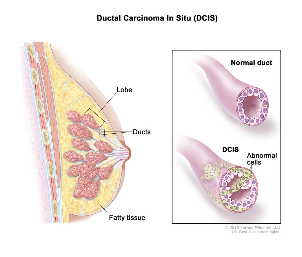 Illustration of Ductal Carcinoma In Situ (DCIS) in the breast. On the left, a cross-section of the breast shows the lobe, ducts, and fatty tissue. On the right, a close-up comparison of a normal duct and a duct affected by DCIS. The normal duct is shown with regular cells, while the DCIS duct shows abnormal cells inside.
