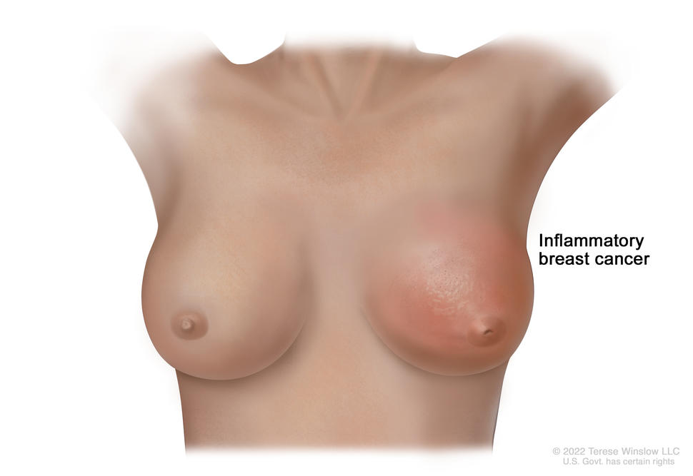Inflammatory breast cancer of the left breast showing redness, swelling, peau d'orange, and an inverted nipple.