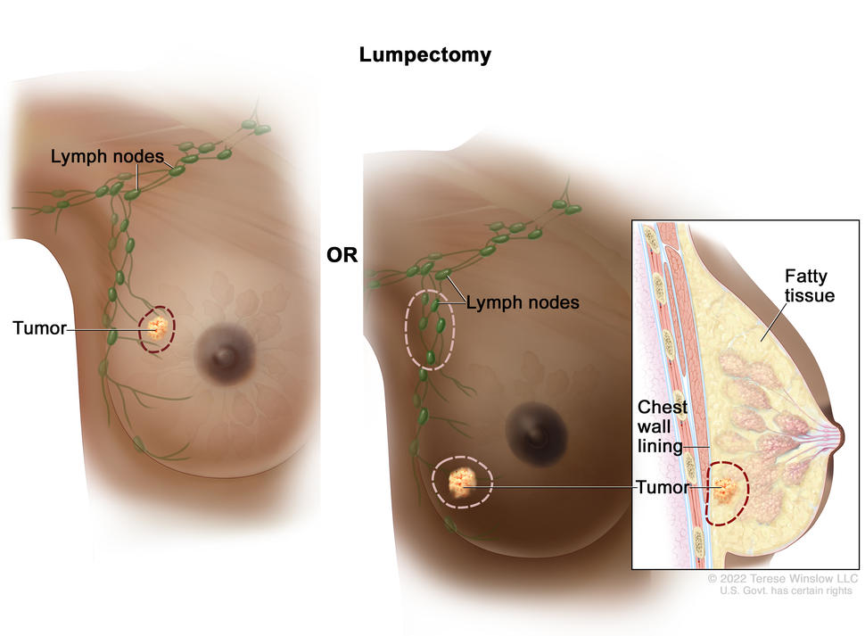 The drawing on the left shows removal of the tumor and some of the normal tissue around it. The drawing on the right shows removal of some of the lymph nodes under the arm and removal of the tumor and part of the chest wall lining near the tumor. Also shown is fatty tissue in the breast.