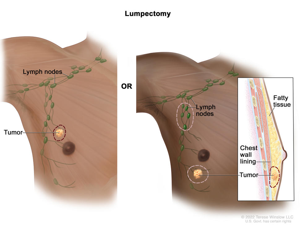 The drawing on the left shows removal of the tumor and some of the normal tissue around it. The drawing on the right shows removal of some of the lymph nodes under the arm and removal of the tumor and part of the chest wall lining near the tumor. Also shown is fatty tissue in the breast.