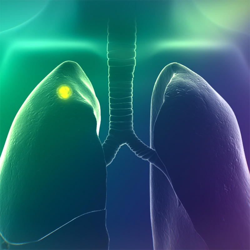 A three-dimensional rendering of the human body with a lung tumor lit up in green.