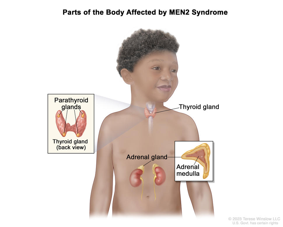 Drawing shows parts of the body affected by MEN2 syndrome, including the thyroid gland, parathyroid glands, and adrenal gland. There are also two insets: one showing the back view of the thyroid gland with the four pea-sized parathyroid glands, and the other showing the inner part of the adrenal gland called the adrenal medulla.