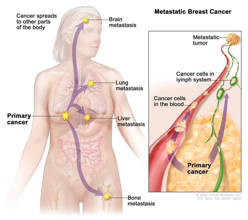 Drawing of a female body shows where primary breast cancer may spread, including the brain, lungs, liver, and bones. An inset shows a close-up view of cancer cells spreading from the breast through the blood and lymph system to another part of the body, to form a metastatic tumor.