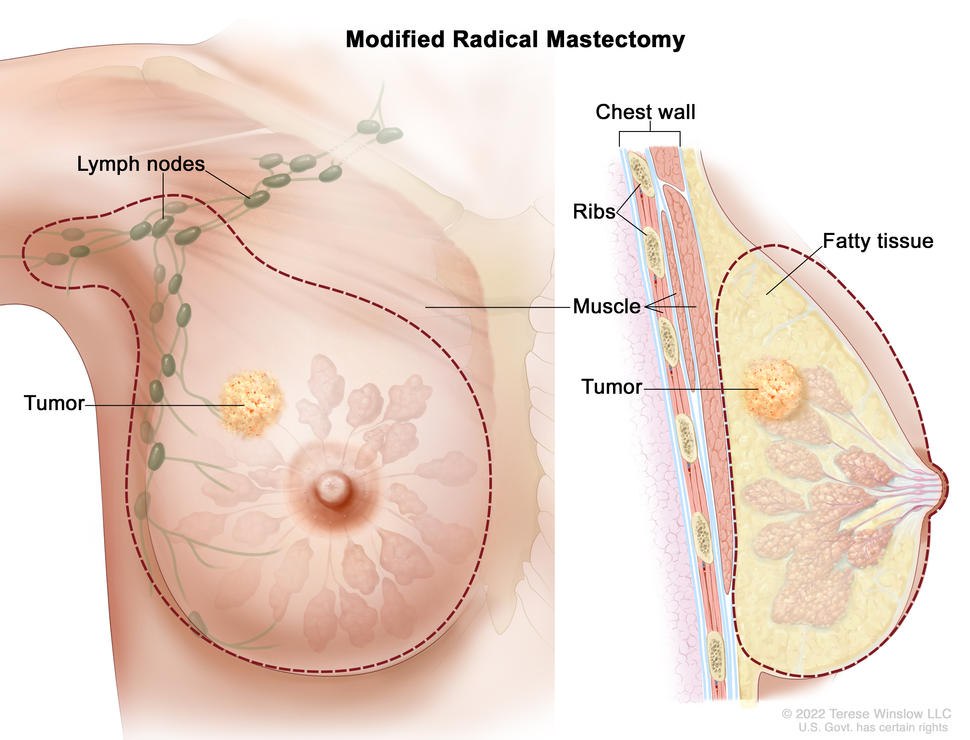 Modified radical mastectomy; the drawing on the left shows the removal of the whole breast, including the  lymph nodes under the arm. The drawing on the right shows a cross-section of the breast, including the fatty tissue and chest wall (ribs  and muscle). A tumor in the breast is also shown.