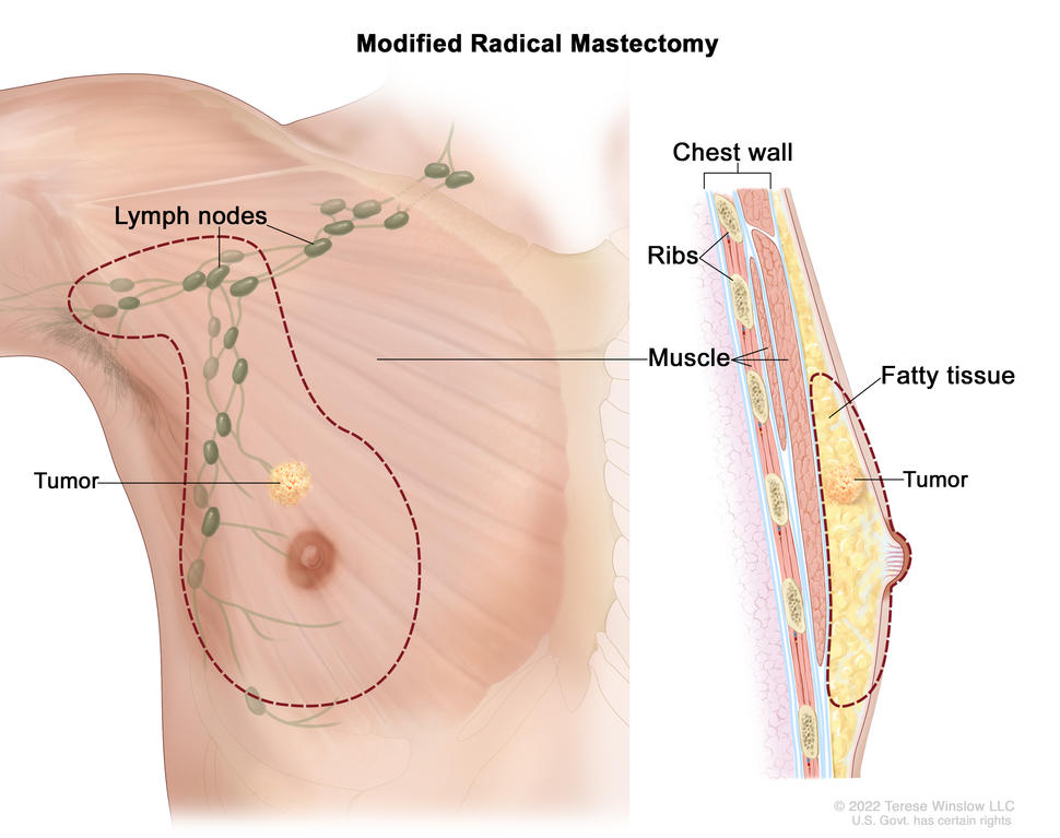 Modified radical mastectomy; the drawing on the left shows the removal of the whole breast, including the lymph nodes under the arm. The drawing on the right shows a cross-section of the breast, including the fatty tissue and chest wall (ribs  and muscle). A tumor is also shown in the breast.