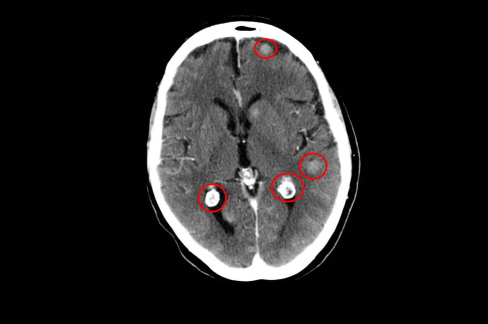 Cross section image of a person's head showing four brain metastases circled in red.