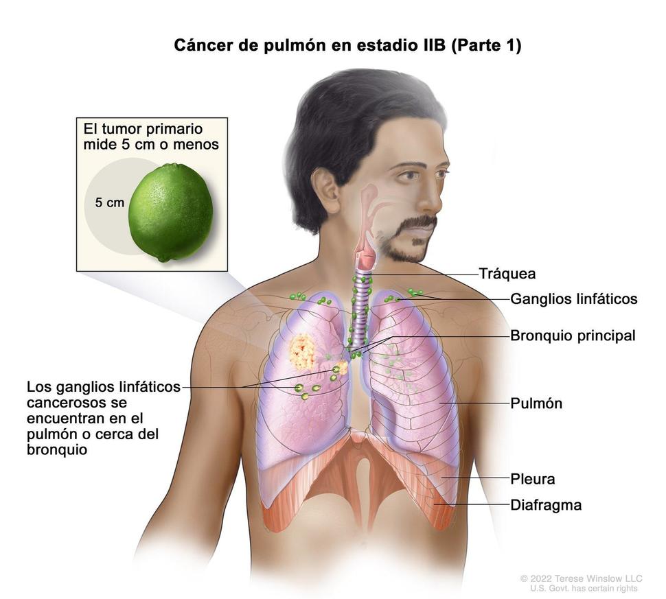 Cáncer de pulmón en estadio IIB. 