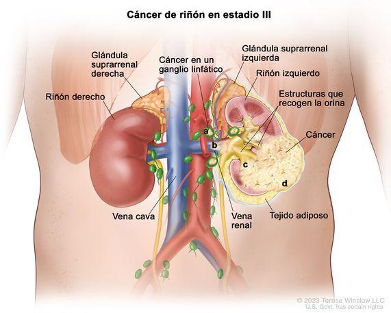 Cáncer de riñón en estadio III