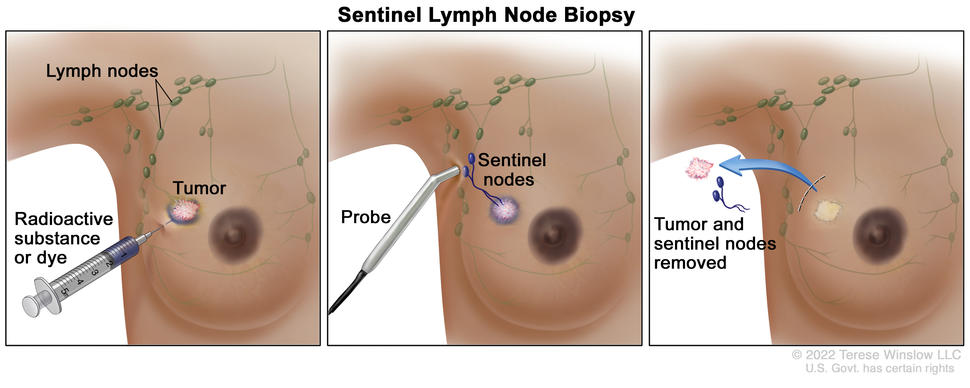 Sentinel lymph node biopsy of the breast; the first panel shows a radioactive substance and/or blue dye being injected near the tumor; the second panel shows that the injected material is followed visually and/or with a probe that detects radioactivity to find the sentinel nodes (the first lymph nodes to which cancer cells are likely to spread from a primary tumor); and the third panel shows the removal of the tumor and the sentinel nodes to check for cancer cells.
