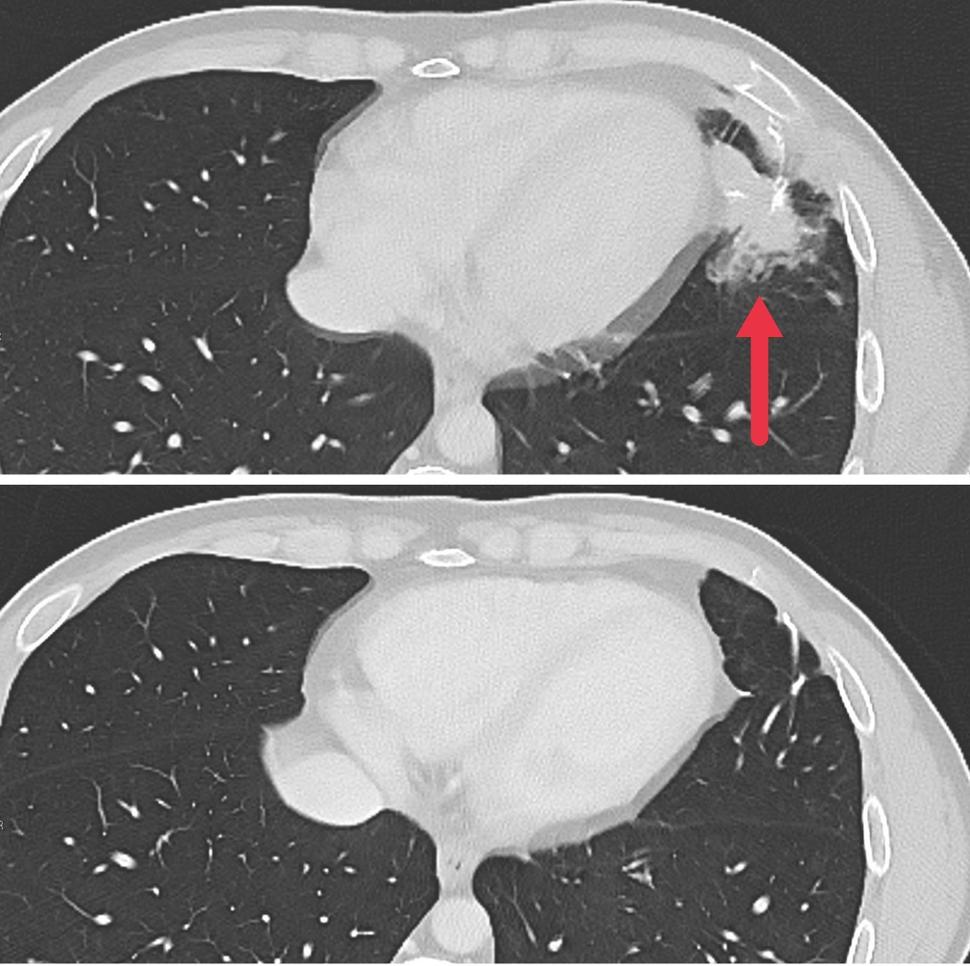 A pair of cross-sectional CT images of a patient's lung. The top image shows an arrow pointing to a metastatic tumor in the lung. The bottom image shows the same lung with no tumor after treatment with the new immunotherapy approach. 