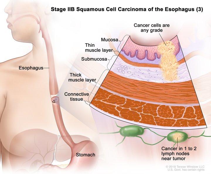 anatomic illustration of stage 2b esophageal cancer, with pop out of cancer cells in nearby lymph nodes 