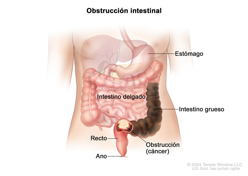 En el dibujo se muestra la anatomía del tubo digestivo del ser humano, que incluye el esófago, el hígado, el estómago, el intestino delgado, el intestino grueso, el recto y el ano. También se observa un tumor que causa una obstrucción u oclusión intestinal al final del intestino grueso, justo antes del recto.