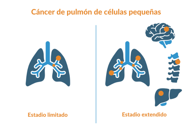 Ilustraciones que muestran que el estadio limitado del cáncer de pulmón se encuentra en un solo pulmón mientras que en el estadio extendido se encuentra en ambos pulmones y en otros órganos como el encéfalo, los huesos y el hígado.
