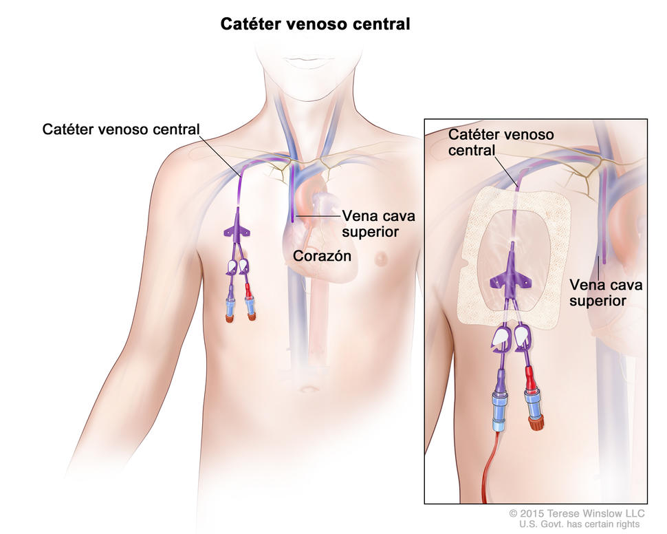 En el dibujo del tronco de un joven, se señala el corazón y la vena cava superior. Al lado derecho del corazón, se observa un catéter venoso central que va desde una vena debajo de la clavícula derecha hasta la vena cava superior, que es una vena grande que se conecta, por encima, con la parte derecha del corazón. En una ampliación, se muestra el catéter venoso central en el lado derecho del tórax cubierto por un apósito plástico transparente.
