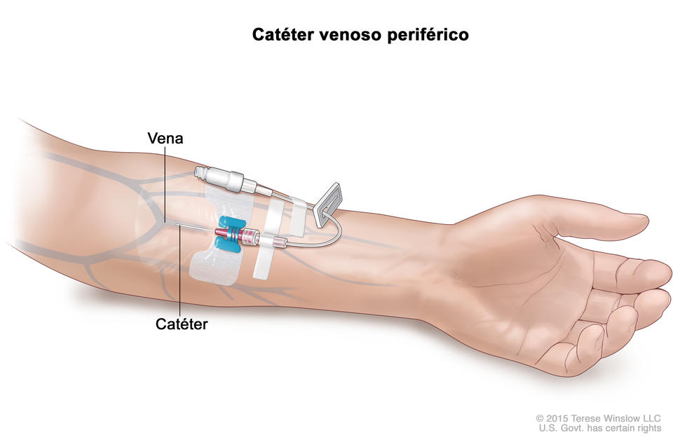 En el dibujo del antebrazo de una persona, se señala la punta de un catéter venoso periférico dentro de una vena, el catéter se conecta con un tubo (sonda) exterior mediante un sistema de fijación sobre la piel. El tubo está pinzado y en el extremo tiene una tapa.