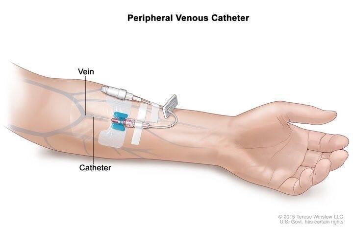 Drawing of a peripheral venous catheter in a vein in the lower part of the arm with the catheter tubing clamped and capped off at the end.