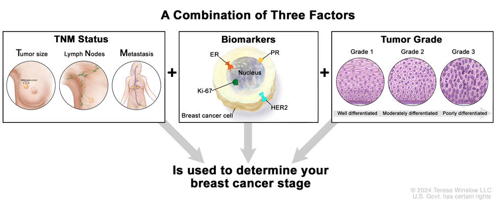 Three-panel image showing TNM status, biomarkers, and tumor grade used to determine breast cancer stage.