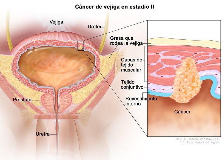 Ilustración del cáncer de vejiga en estadio II, que también se llama cáncer de vejiga con invasión muscular. En un recuadro se observa el cáncer en el revestimiento interno de la vejiga y en la capa de tejido conjuntivo y las capas musculares de la vejiga.